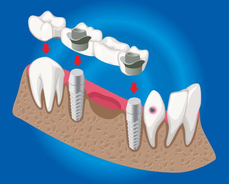 Denture