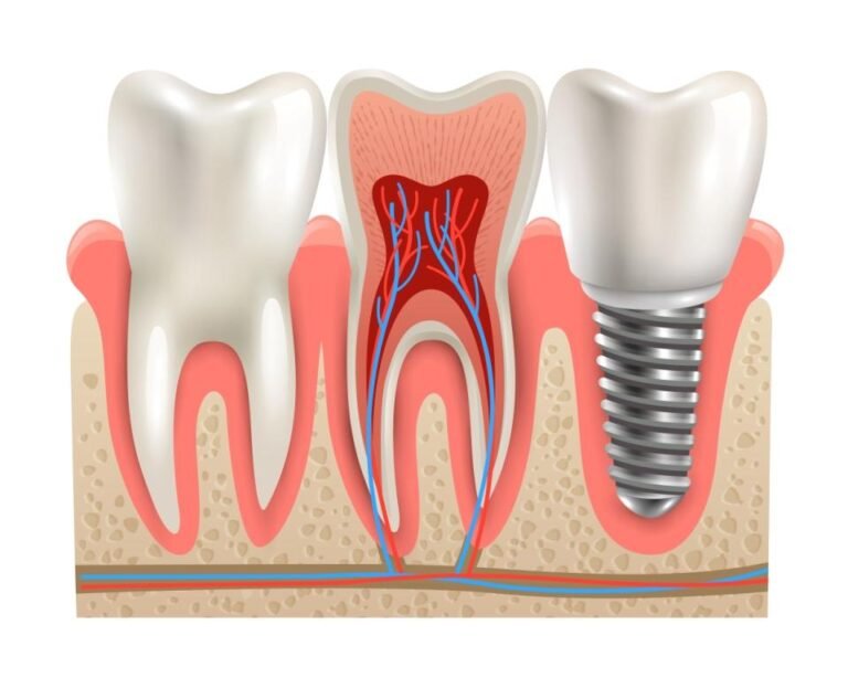 Root canal treatment