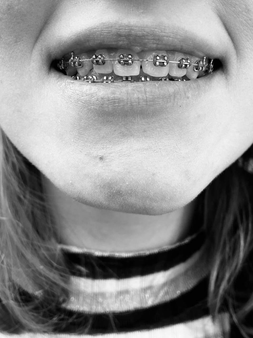 braces