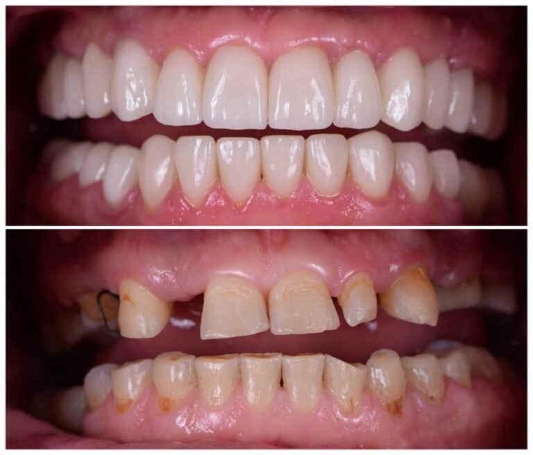 Full-Mouth-Rehablitatiom