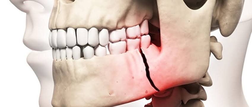 Jaw fracture
