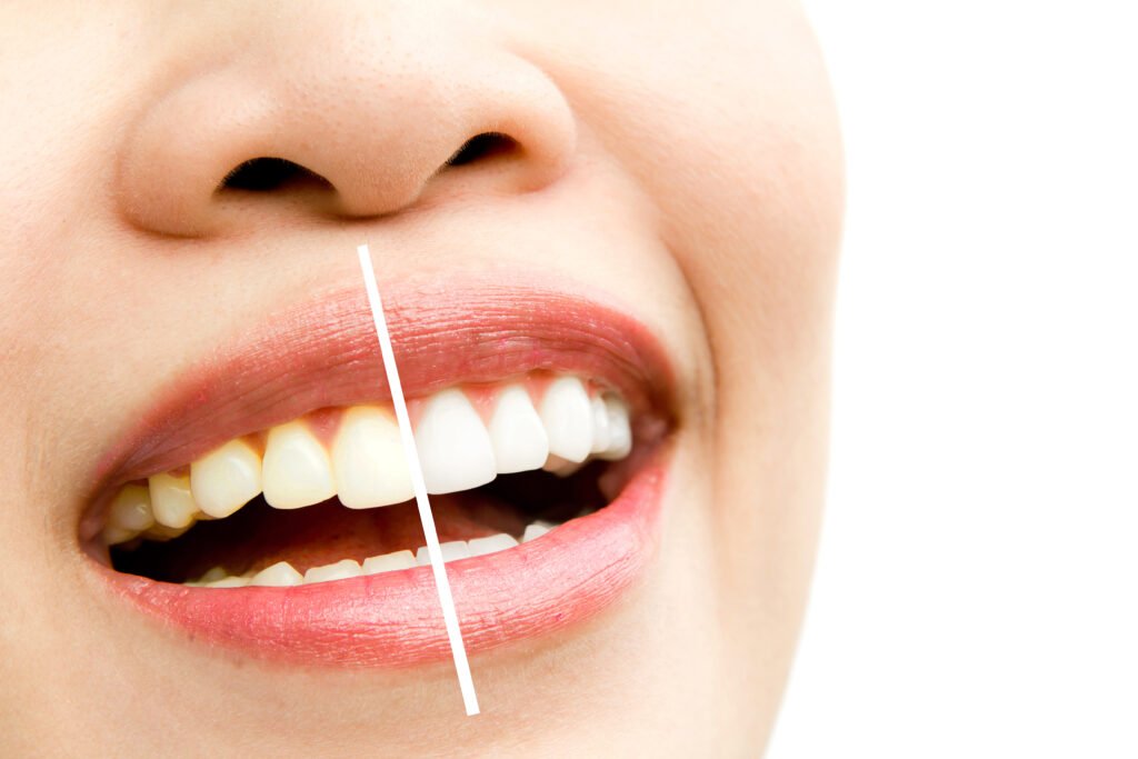 Veneer