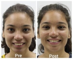Orthodontic treatment in a young female patient.
