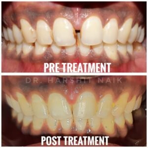 Orthodontic treatment